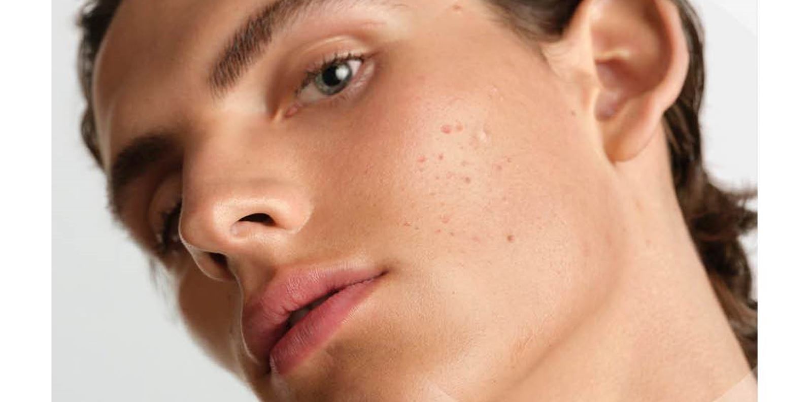 BIODERMA стартира есенната кампания срещу акнето