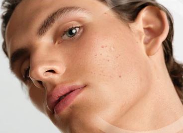 BIODERMA стартира есенната кампания срещу акнето