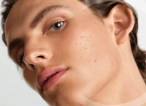 BIODERMA стартира есенната кампания срещу акнето